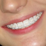 Niềng răng móm hết bao nhiêu tiền ?