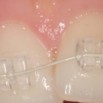 Chi phí niềng răng mắc cài sứ giá bao nhiêu ?