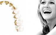 Niềng răng mặt trong cho hiệu quả cao