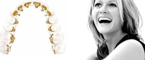 Chỉnh nha niềng răng khắc phục tình trạng hô móm lệch lạc ?