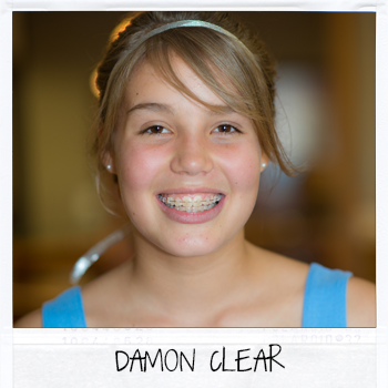 Chi phí niềng răng mắc cài tự đóng