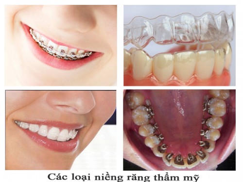 Giải đáp thắc mắc niềng răng có làm răng yếu đi không ?