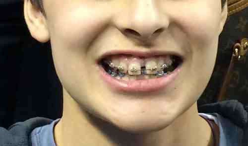 Niềng 2 răng cửa giá bao nhiêu tiền ?