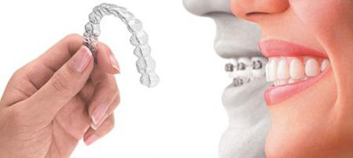 Niềng răng invisalign giá bao nhiêu tiền ?