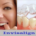 Niềng răng không mắc cài có đau không ?