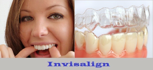 Niềng răng không mắc cài có đau không ?