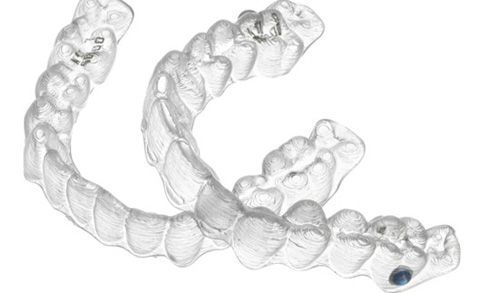 Niềng răng không mắc cài cho hàm răng mọc chen chúc