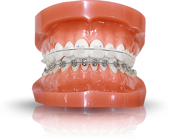 Niềng răng mất bao lâu thì hoàn thành ?