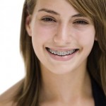 Chi phí niềng răng