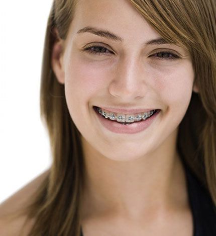 Chi phí niềng răng