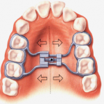 Tìm hiểu chỉnh nha tháo lắp có ốc nong rộng