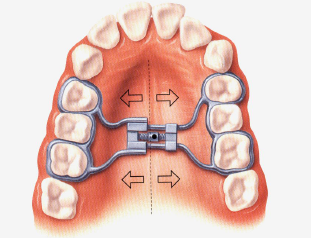 Tìm hiểu chỉnh nha tháo lắp có ốc nong rộng
