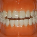 Tìm hiểu ưu và nhược điểm của chỉnh nha tháo lắp