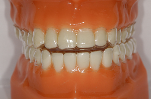 Tìm hiểu ưu và nhược điểm của chỉnh nha tháo lắp