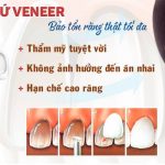 Bọc răng sứ veneer