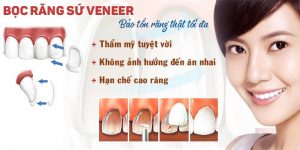 Bọc răng sứ veneer
