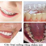 Tiêu chí lựa chọn bác sĩ niềng răng chỉnh nha